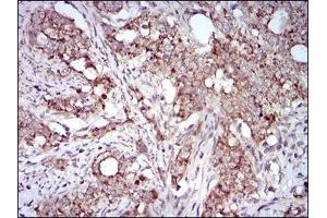 Immunohistochemical analysis of paraffin-embedded human cervical cancer tissues using GAB2 mouse mAb with DAB staining. (GAB2 抗体  (AA 332-476))