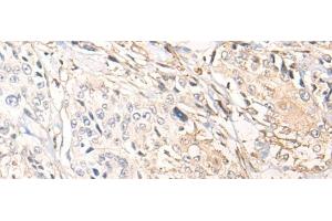 Immunohistochemistry of paraffin-embedded Human prost ate cancer tissue using NREP Polyclonal Antibody at dilution of 1:35(x200) (NREP 抗体)