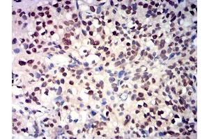 Immunohistochemical analysis of paraffin-embedded bladder cancer tissues using RBBP7 mouse mAb with DAB staining. (RBBP7 抗体  (AA 1-200))