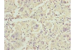 Immunohistochemistry of paraffin-embedded human liver cancer using ABIN7149016 at dilution of 1:100 (CDO1 抗体  (AA 1-200))