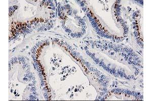 Immunohistochemical staining of paraffin-embedded Adenocarcinoma of Human colon tissue using anti-FGFR2 mouse monoclonal antibody. (FGFR2 抗体)