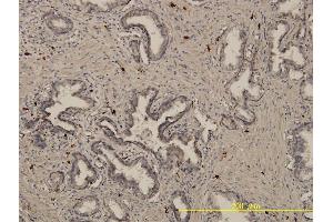Immunoperoxidase of monoclonal antibody to EML4 on formalin-fixed paraffin-embedded human prostate cancer. (EML4 抗体  (AA 1-62))