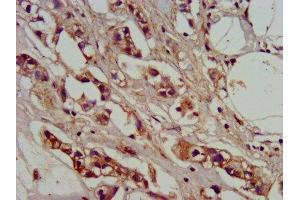 IHC image of ABIN7142146 diluted at 1:400 and staining in paraffin-embedded human breast cancer performed on a Leica BondTM system. (ADO 抗体  (AA 137-270))