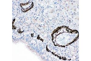 IHC-P: FABP6 antibody testing of human lung cancer tissue (FABP6 抗体  (N-Term))