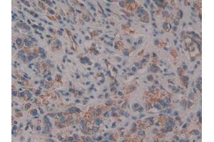 DAB staining on IHC-P; Samples: Human Prostate cancer Tissue (CD109 抗体  (AA 1146-1390))