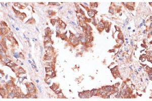 Immunohistochemistry of paraffin-embedded Human lung cancer using KCNH2 Polyclonal Antibody at dilution of 1:100 (40x lens). (KCNH2 抗体)