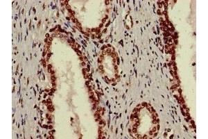 Immunohistochemistry of paraffin-embedded human prostate cancer using ABIN7175905 at dilution of 1:100