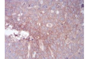 Immunohistochemical analysis of paraffin-embedded ovarian cancer tissues using GLI1 mouse mAb with DAB staining.