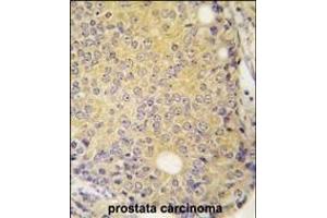 Forlin-fixed and paraffin-embedded hun prostata carcino tissue reacted with P3K5 ANtibody  g , which was peroxidase-conjugated to the secondary antibody, followed by DAB staining. (ASK1 抗体  (AA 821-849))