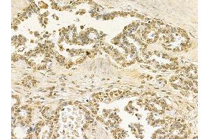 STAT5B Mouse Monoclonal Antibody at 1/100 staining human ovarian cancer by IHC-P. (STAT5B 抗体  (C-Term))