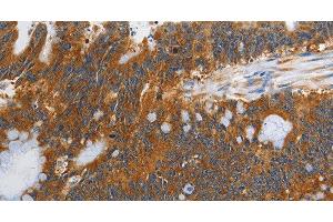 Immunohistochemistry of paraffin-embedded Human colon cancer tissue using PI 3 Kinase Class 3 Polyclonal Antibody at dilution 1:40 (PIK3C3 抗体)