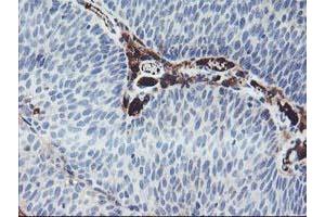 Immunohistochemical staining of paraffin-embedded Carcinoma of Human bladder tissue using anti-IGJ mouse monoclonal antibody. (IGJ 抗体)