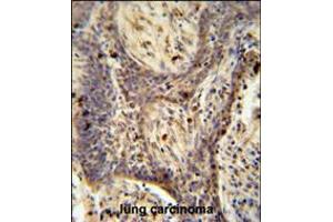 PPRC1 antibody immunohistochemistry analysis in formalin fixed and paraffin embedded human lung carcinoma followed by peroxidase conjugation of the secondary antibody and DAB staining. (PPRC1 抗体  (C-Term))