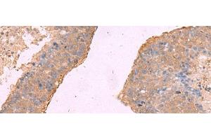 Immunohistochemistry of paraffin-embedded Human liver cancer tissue using NIPSNAP1 Polyclonal Antibody at dilution of 1:50(x200) (NIPSNAP1 抗体)