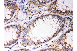 Anti- BAK Picoband antibody, IHC(P) IHC(P): Human Intestinal Cancer Tissue (BAK1 抗体  (AA 22-211))