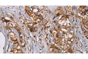 Immunohistochemistry of paraffin-embedded Human breast cancer using NDUFS1 Polyclonal Antibody at dilution of 1:50 (NDUFS1 抗体)