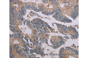 Immunohistochemistry of Human colon cancer using MMP20 Polyclonal Antibody at dilution of 1:40 (MMP20 抗体)