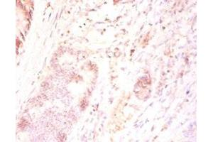 Immunohistochemistry of paraffin-embedded human colon cancer using ABIN7165346 at dilution of 1:50 (TMEM185B 抗体  (AA 1-370))