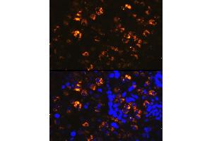 Immunofluorescence analysis of human lung cancer cells using NAPSA Rabbit pAb (ABIN6128367, ABIN6144368, ABIN6144369 and ABIN6221232) at dilution of 1:100 (40x lens). (NAPSA 抗体  (AA 25-250))
