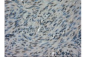 Immunohistochemical staining of paraffin-embedded Carcinoma of kidney tissue using anti-TRIB2mouse monoclonal antibody. (TRIB2 抗体)