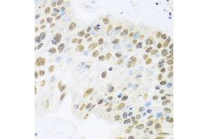 Immunohistochemistry of paraffin-embedded human lung cancer using ZBTB17 antibody (ABIN6133380, ABIN6150370, ABIN6150371 and ABIN6224531) at dilution of 1:100 (40x lens). (ZBTB17 抗体  (AA 121-360))