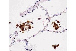 Immunohistochemical analysis of paraffin-embedded human lung using FABP4 antibody at 1:25 dilution.