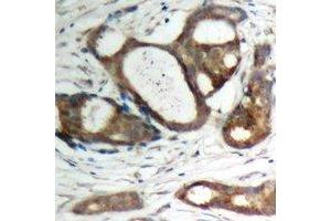 Immunohistochemical analysis of Plakophilin 2 staining in human prostate cancer formalin fixed paraffin embedded tissue section. (Plakophilin 2 抗体  (C-Term))