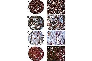 Immunohistochemisty of PTPN13 in formalin-fixed, paraffin embedded ovarian carcinoma cores from a tissue microarray. (PTPN13 抗体)