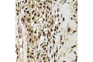 Immunohistochemistry of paraffin-embedded human kidney cancer using ACTL6B antibody.