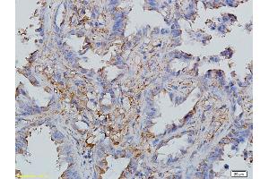 Formalin-fixed and paraffin embedded human endometrial cancer labeled with Anti-CCL19/MIP-3 beta Polyclonal Antibody, Unconjugated (ABIN740505) followed by conjugation to the secondary antibody (CCL19 抗体  (AA 26-108))