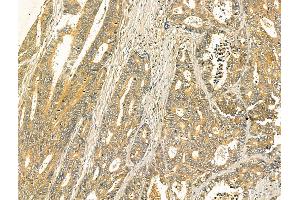 ABIN7094411 and ABIN7098458 at 1/100 staining Human colorectal cancer by IHC-P. (ODF2L 抗体  (N-Term))
