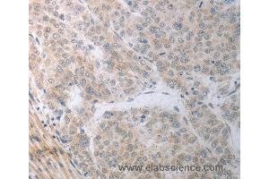 Immunohistochemistry of Human liver cancer using RBMS3 Polyclonal Antibody at dilution of 1:70 (RBMS3 抗体)