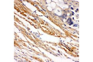 Anti- C-Kit Picoband antibody, IHC(P) IHC(P): Human Intestinal Cancer Tissue (KIT 抗体  (AA 26-285))