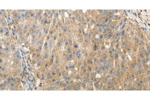 Immunohistochemistry of paraffin-embedded Human ovarian cancer using SULT1E1 Polyclonal Antibody at dilution of 1:30 (SULT1E1 抗体)