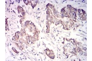 Immunohistochemical analysis of paraffin-embedded stomach cancer tissues using CYCS mouse mAb with DAB staining. (Cytochrome C 抗体  (AA 1-105))