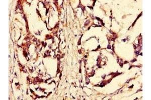 Immunohistochemistry of paraffin-embedded human gastric cancer using ABIN7168184 at dilution of 1:100 (MSK2 抗体  (AA 237-393))