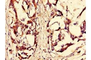 Immunohistochemistry of paraffin-embedded human gastric cancer using ABIN7168184 at dilution of 1:100 (MSK2 抗体  (AA 237-393))