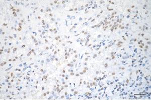 Immunohistochemistry was performed on paraffin-embedded human lung adenocarcinoma using SNRPA1 antibody (ABIN7800379), 1:200).
