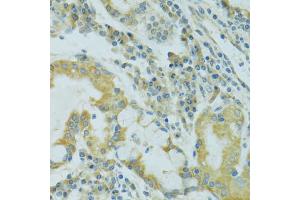 Immunohistochemistry of paraffin-embedded human lung cancer using TJP2 antibody.