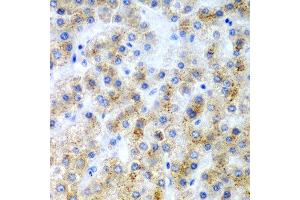 Immunohistochemistry of paraffin-embedded human liver cancer using LY86 antibody at dilution of 1:200 (40x lens). (LY86 抗体)