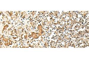 Immunohistochemistry of paraffin-embedded Human prost at e cancer tissue using HLA-DRB1 Polyclonal Antibody at dilution of 1:75(x200) (HLA-DRB1 抗体)