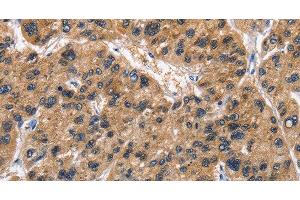 Immunohistochemistry of paraffin-embedded Human liver cancer tissue using ABI3BP Polyclonal Antibody at dilution 1:50 (ABI3BP 抗体)