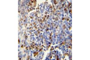 Immunohistochemistry analysis in formalin fixed andparaffin embedded human lung carcinoma reactedwith FOSL2 Antibody (Center) Cat. (FOSL2 抗体  (Middle Region))