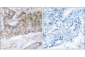 Immunohistochemistry analysis of paraffin-embedded human breast carcinoma tissue, using DHRS11 Antibody. (DHRS11 抗体  (AA 111-160))