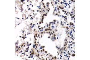 Immunohistochemistry of paraffin-embedded human lung cancer using ID3 antibody. (ID3 抗体)