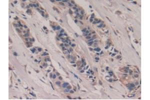 IHC-P analysis of Human Breast Cancer Tissue, with DAB staining. (Poliovirus Receptor 抗体  (AA 56-309))