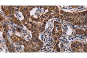 Immunohistochemistry of paraffin-embedded Human lung cancer tissue using GRK3 Polyclonal Antibody at dilution 1:50 (ADRBK2 抗体)