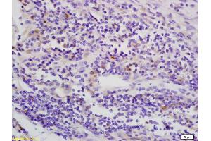 Formalin-fixed and paraffin embedded human esophagus carcinoma labeled with Anti-phospho-LKB1 (Thr363) Polyclonal Antibody, Unconjugated (ABIN687877) at 1:200 followed by conjugation to the secondary antibody and DAB staining (LKB1 抗体  (pThr363))