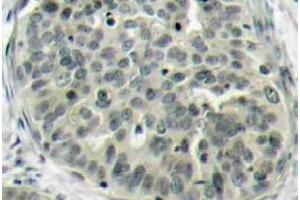 Immunohistochemistry (IHC) analyzes of p-Catenin-beta antibody in paraffin-embedded human breast carcinoma tissue. (CTNNB1 抗体  (pSer37))
