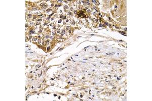 Immunohistochemistry of paraffin-embedded human mammary cancer using ARRB2 antibody. (Arrestin 3 抗体)